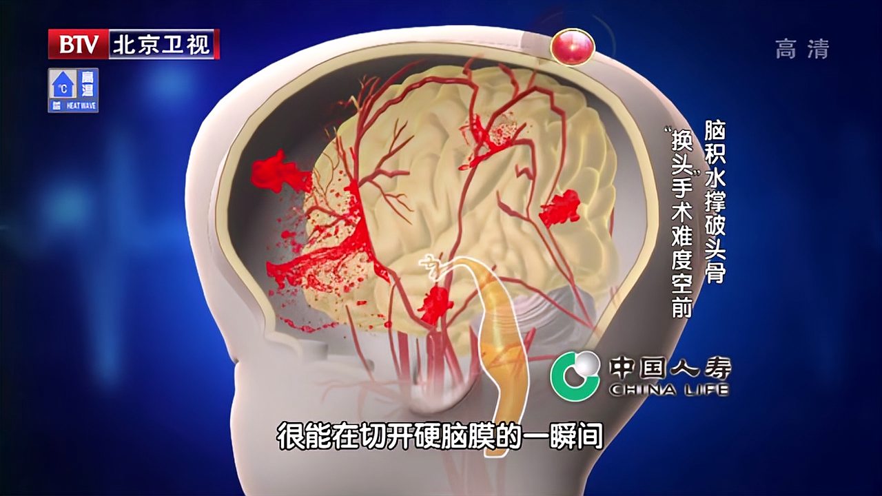 [图]女童脑积水撑破头骨,“换头”手术难度空前,家人泣不成声