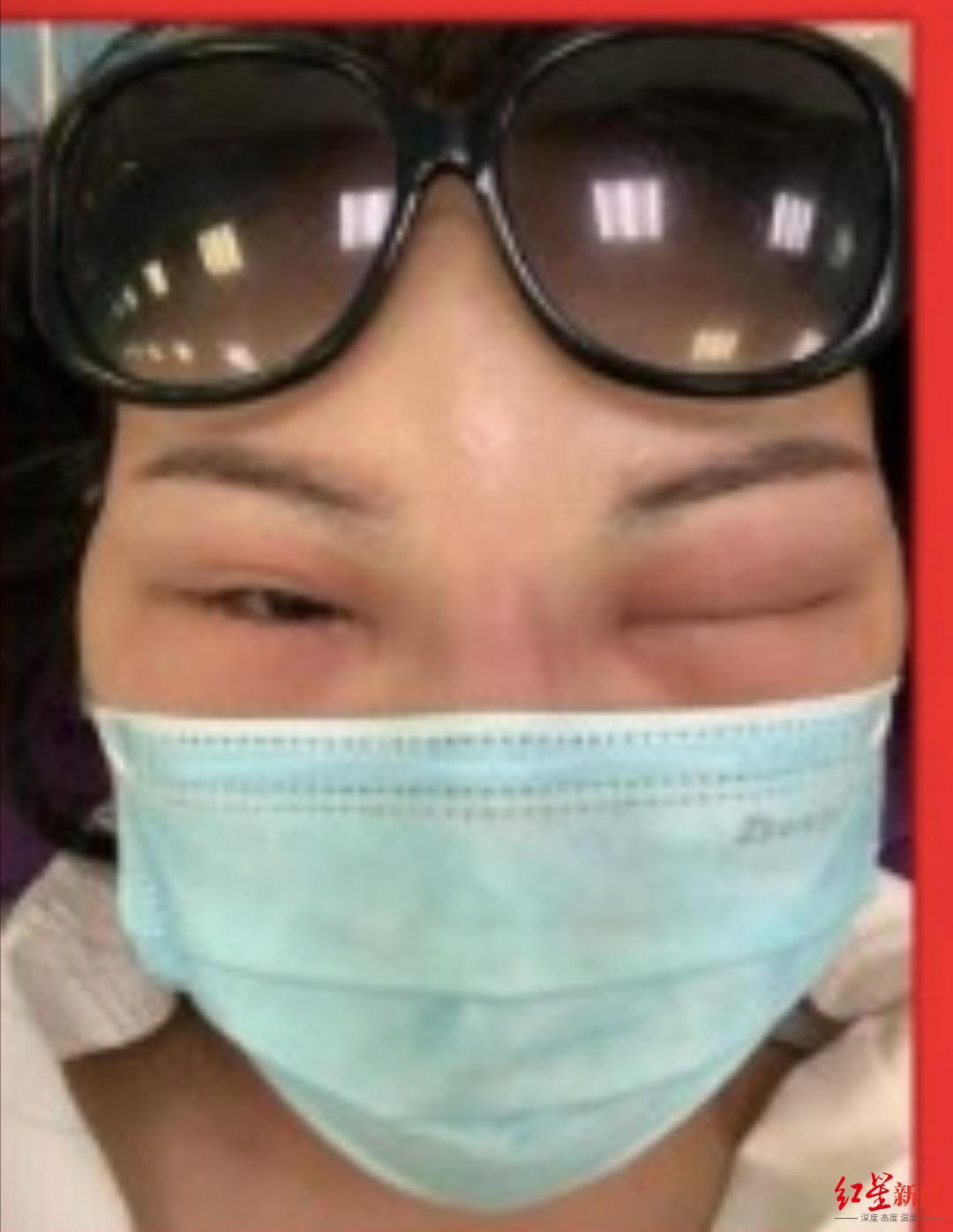 玻尿酸残留物致面部反复肿大，王女士维权之路何去何从？