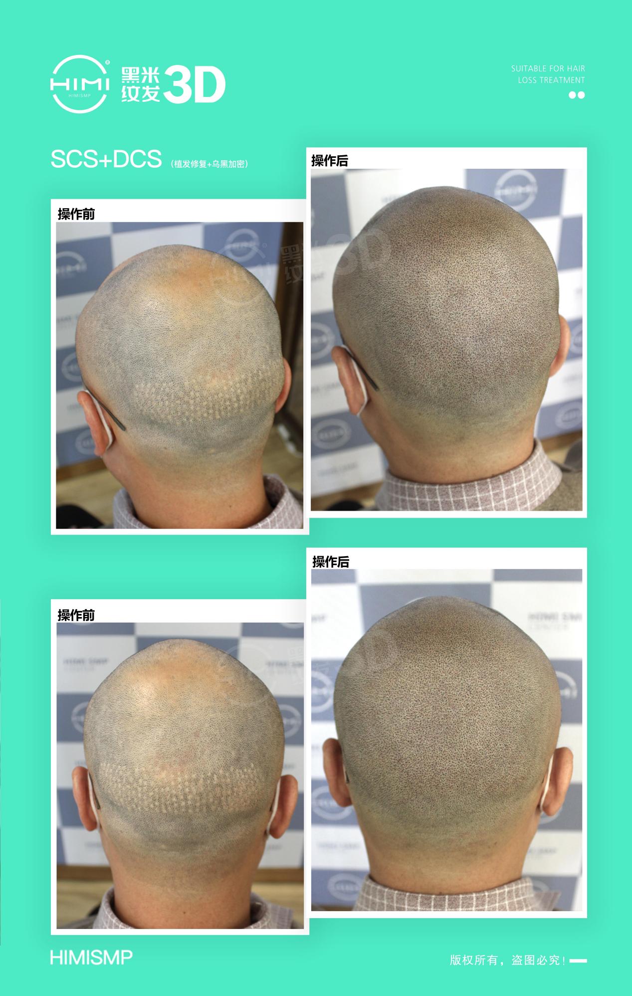 黑米3d纹发:植发后留下永久性疤痕,选择纹头可以发修复吗?