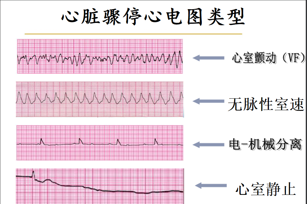 室性停搏心电图图片