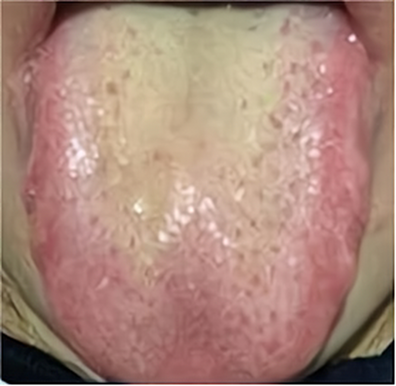 舌红苔黄,舌面红点齿痕重,是痰湿化热了   大家可以看到这个舌象,舌头