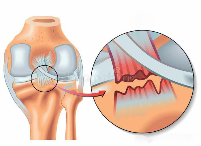 膝关节后交叉韧带损伤