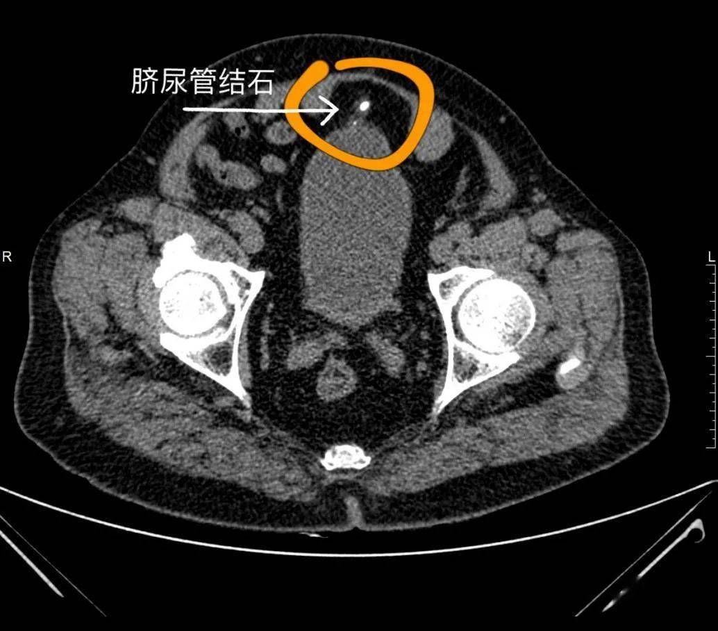 脐尿管结石图片图片