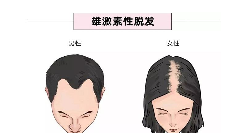 黑米3d纹发:怎么判断自己的脱发是不是雄性激素脱发?