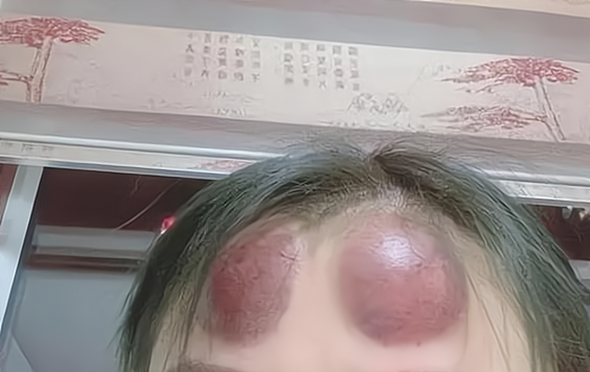 告诉我额头上拔罐能治头疼的网友,我还有良心吗?