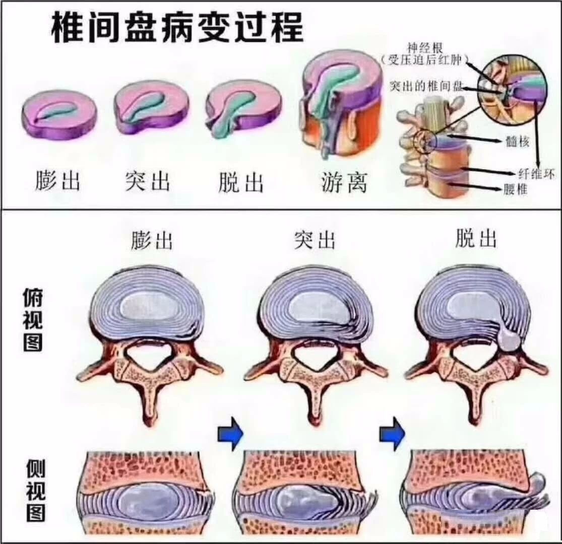 腰椎间盘突出,纤维环破裂是怎么回事?这种情况需要治疗吗?