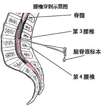 腰穿的科普知识