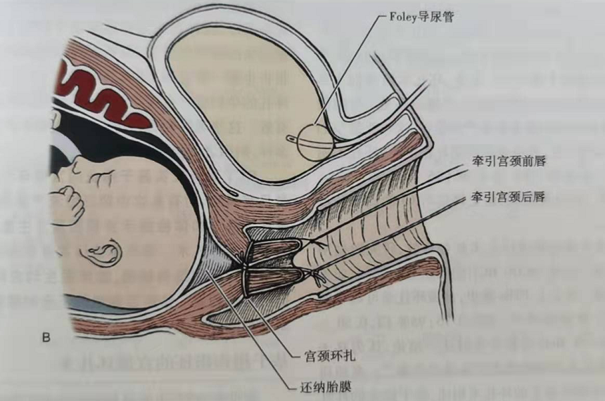 宫颈前唇增生图片图片