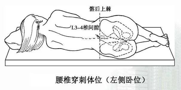 腰穿的科普知识