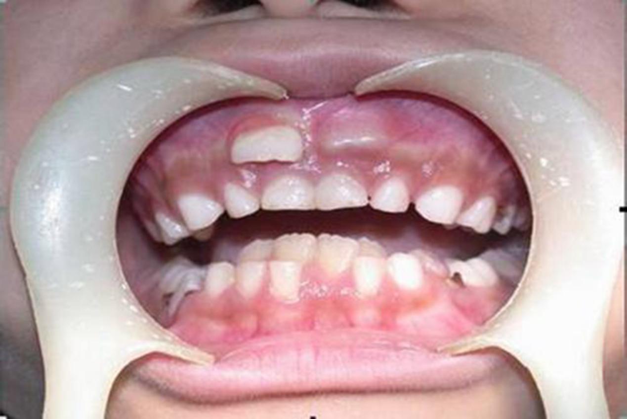门牙从牙龈上方长出图片
