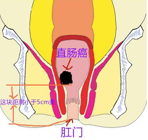 直腸癌術後腹瀉,大便失禁?千萬不能單靠止瀉,要從根源調理