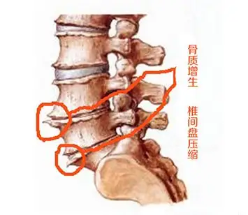 腰椎骨质增生怎么治疗图片