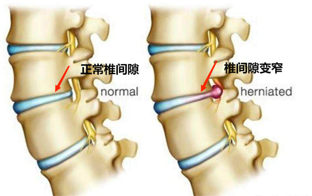 腰椎间盘突出症的运动疗法之吊单杠