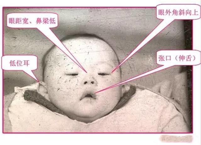 有唐氏综合征的孩子,面部是什么样子?新生儿期能看出来吗