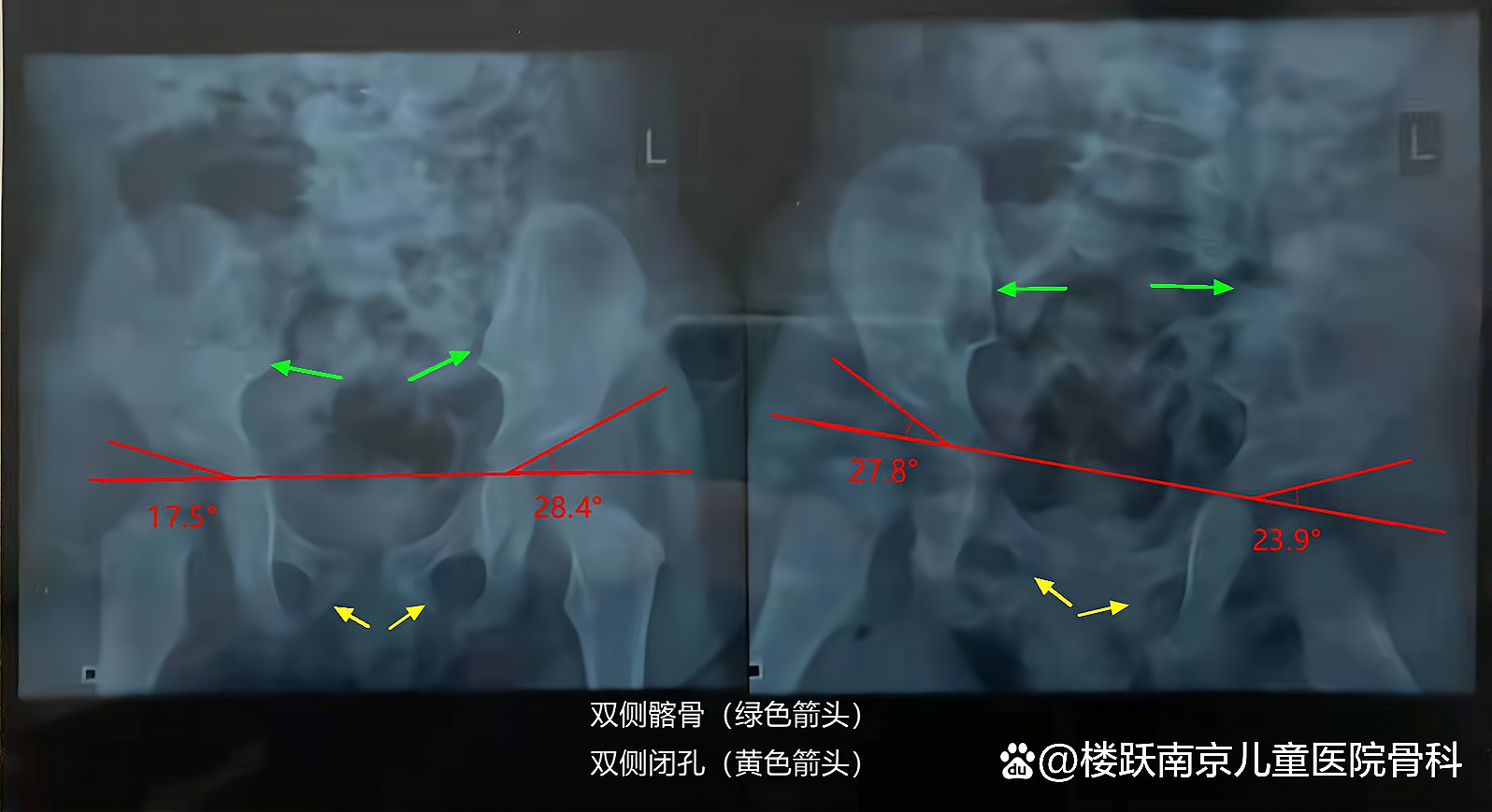 儿童骨盆片子图片