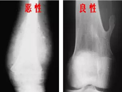 赵赫因癌去世 中老年出现7个症状警惕骨癌