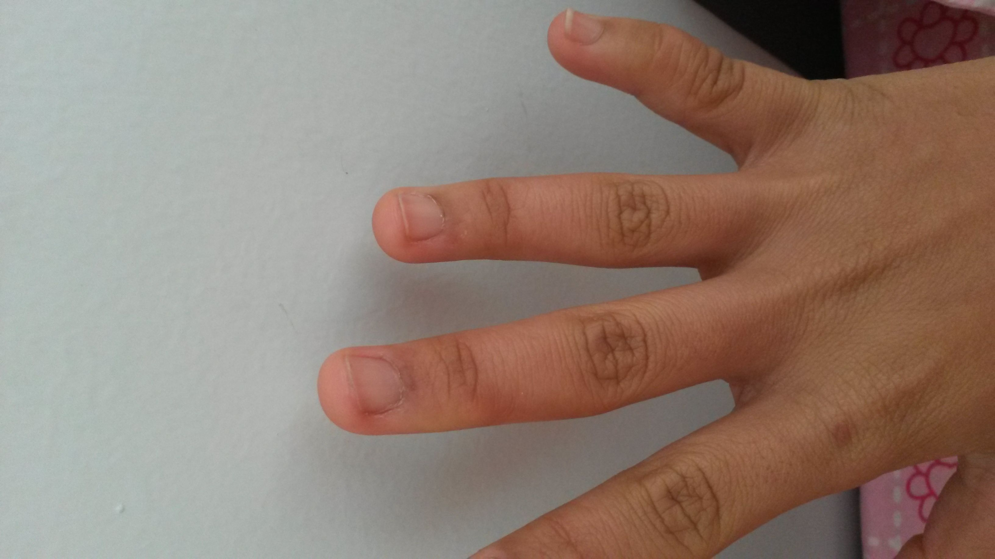 手指结节的症状图片图片