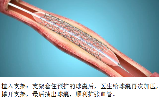 心肌梗塞手术支架图片图片