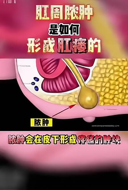 复兴中医肛肠:肛周脓肿是如何形成肛瘘的?