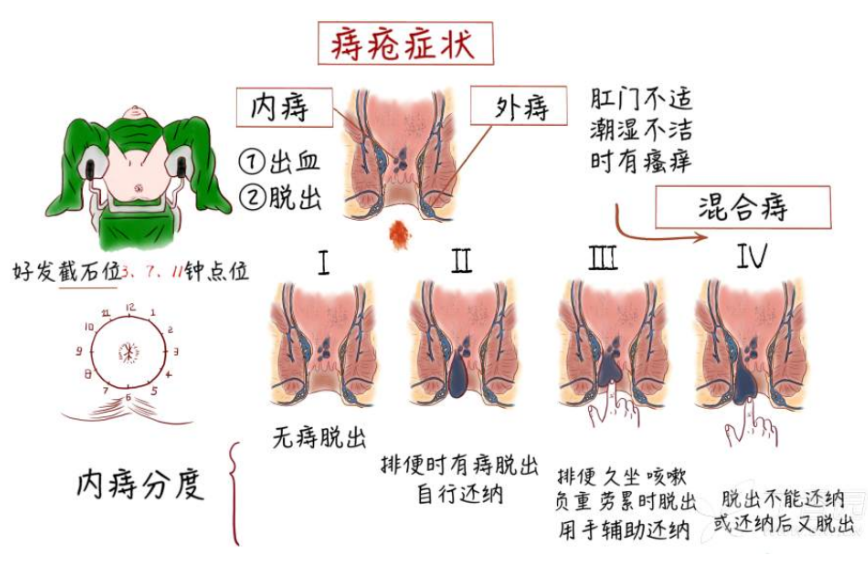 外痔疮图解图片