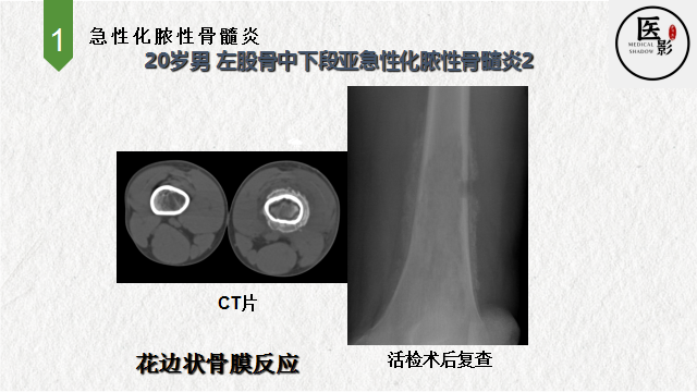 骨髓炎片子图片图片