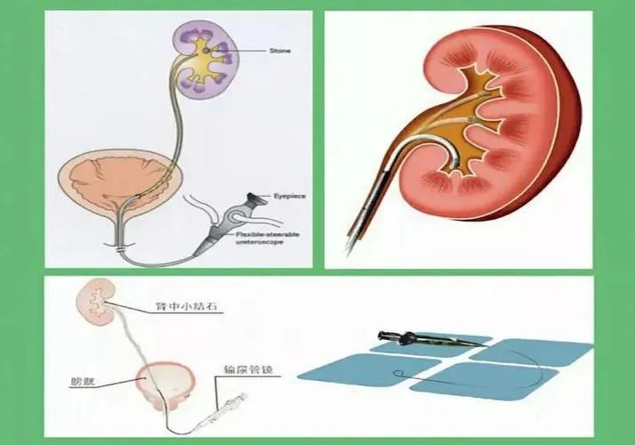 输尿管软镜下钬激光碎石术:微创碎石了无痕