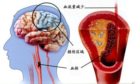 脑梗死位置图图片