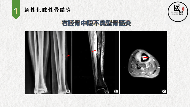 骨髓炎片子图片图片