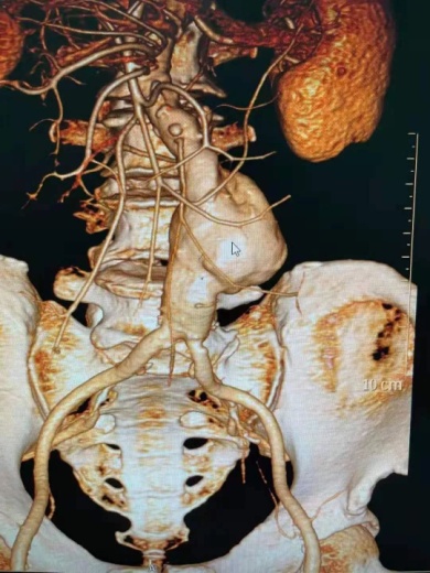 腹主动脉瘤图片真人图片