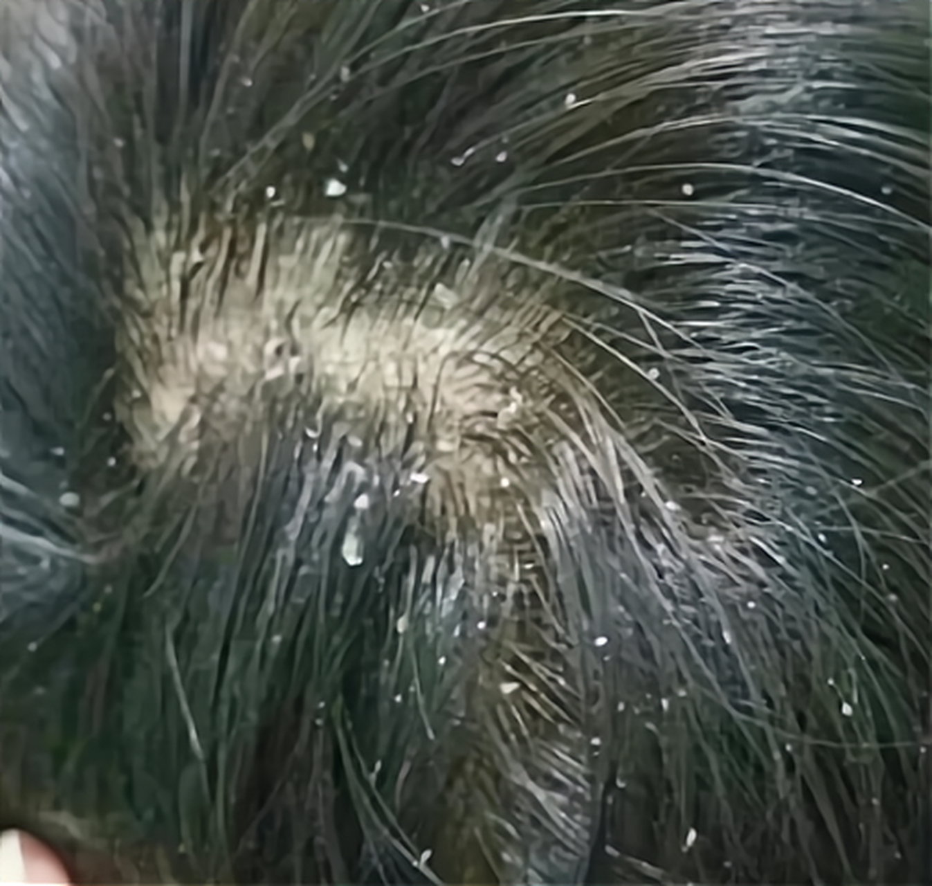 王先生最近头皮屑很多, 特别的痒,    有时候衣服上,也会掉落很多鳞屑