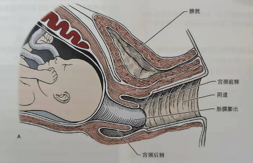 宫颈前唇增生图片图片