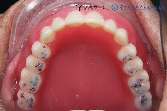 病例分享|廣醫口腔醫院使用數字化哥弓托盤引導全口義齒修復