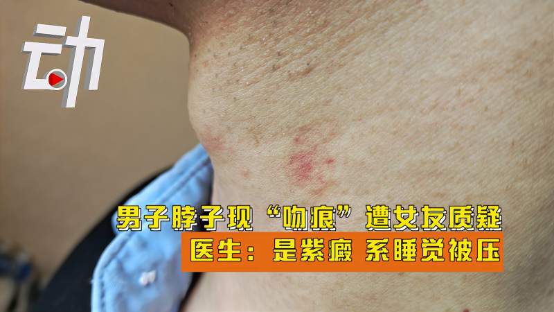 男子脖子现“吻痕”遭女友质疑 医生：是紫癜 系睡觉被压,社会,奇闻轶事,好看视频