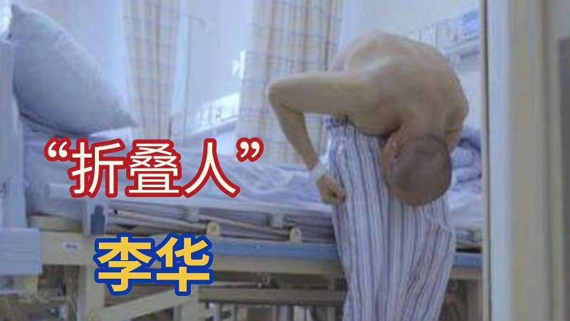 历经四次手术后曾让全网关注的折叠人李华如今怎么样了