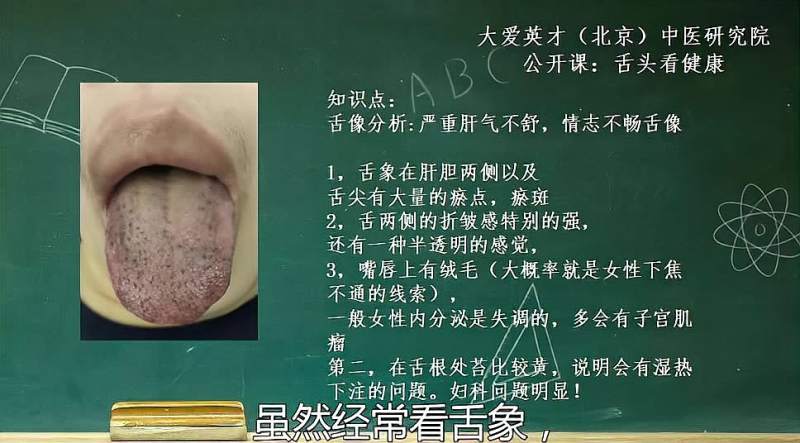 舌象分析 舌尖有大量瘀点 长期焦虑 内分泌失调的女性舌象讲解 健康养生 健康常识 好看视频