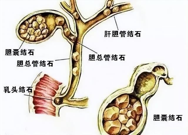 因胆囊结石伴胆囊炎进行手术