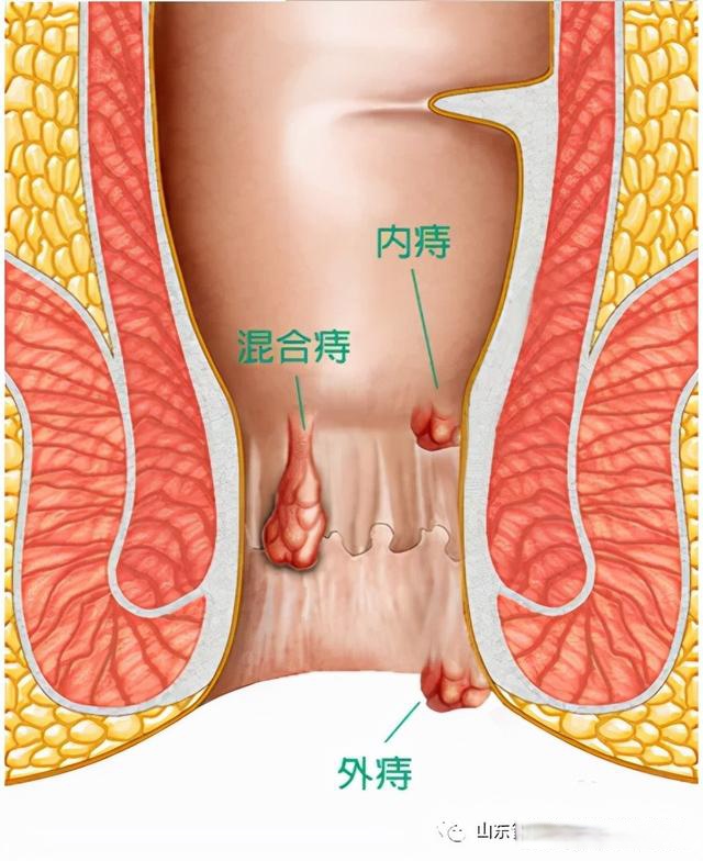 痔疮图片怎么治疗图片