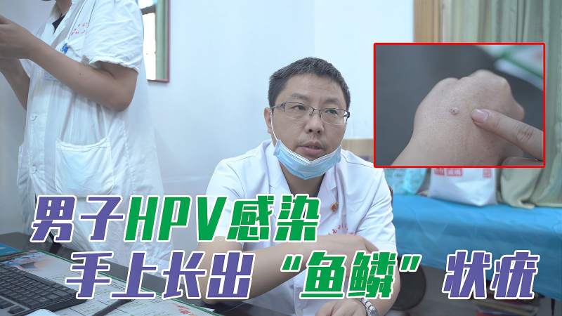 男子hpv感染手上长出鱼鳞状疣抠破还会传染