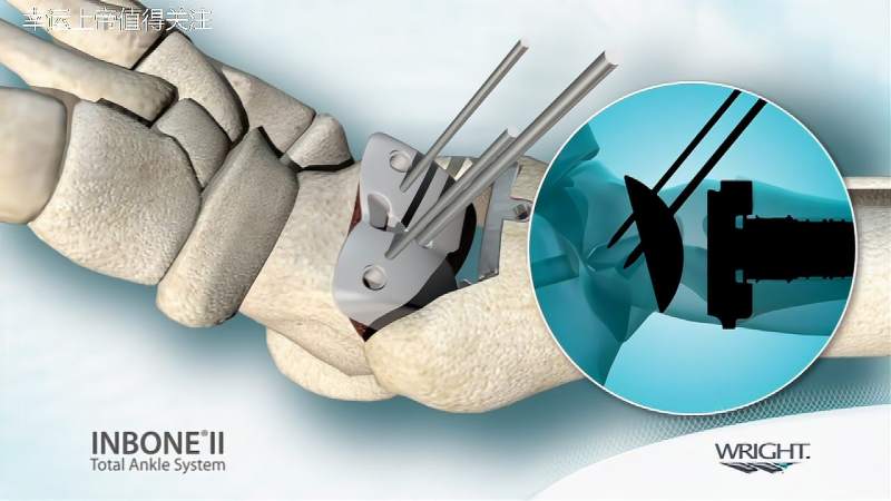 全踝关节置换操作动画演示