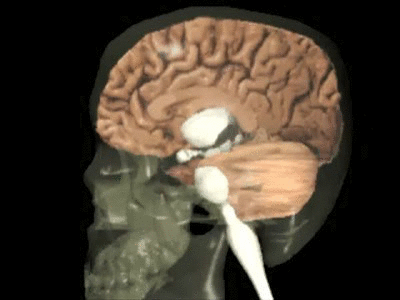 脑疝动图图片