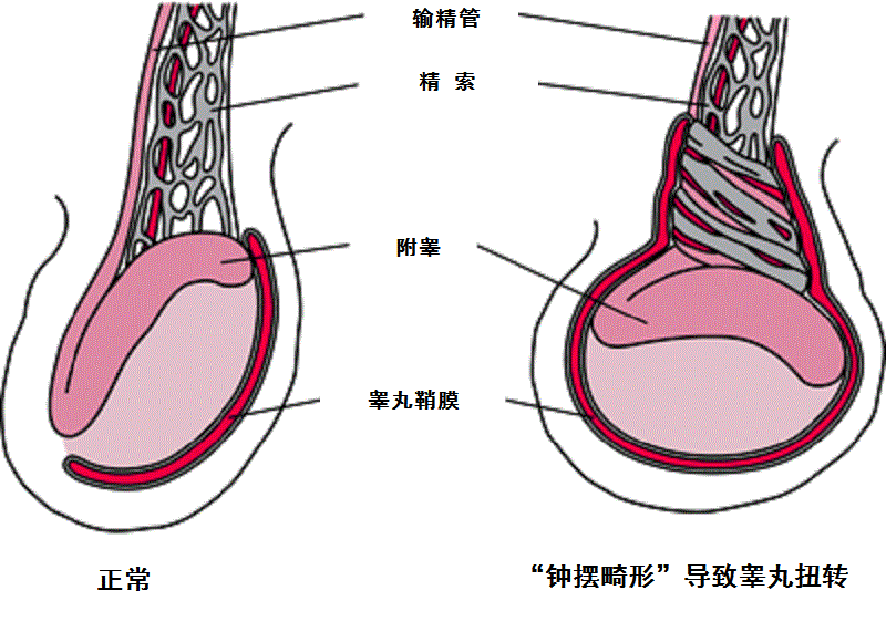 鞘膜积液的原因是什么临床表现是什么如何预防