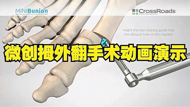 微创拇外翻手术动画演示