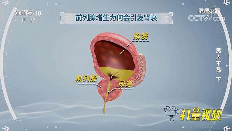 尿频尿急尿不尽警惕前列腺增生严重会引发肾衰健康之路 健康养生 健康常识 好看视频