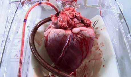 在心脏移植手术过程中,这是正进行体外循环转流的一颗待植入受体体内