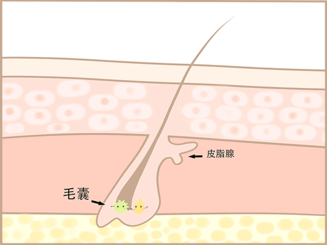 每个毛囊都连着一个小偏房——皮脂腺 里面住着一群快活的厌氧菌 每天